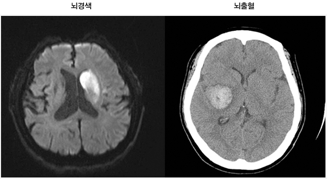 [사진] 뇌경색(좌) /  뇌출혈(우)