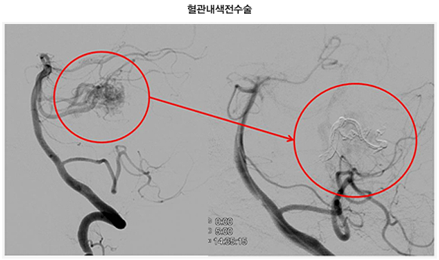 [사진] 혈관내색전수술