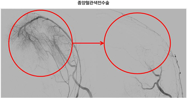 [사진] 종양혈관색전수술
